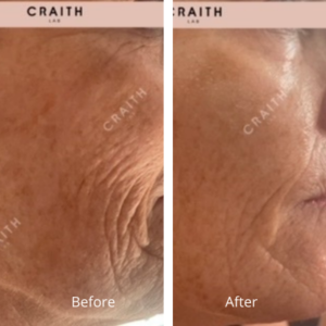 Voor en na foto's van een retinol behandeling voor een jeugdige huid. Foto's van collega Natasja de Koning uit Roermond