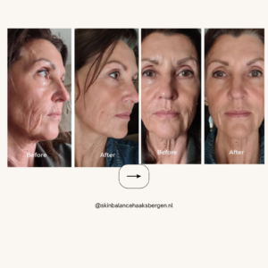 Retinol kuur