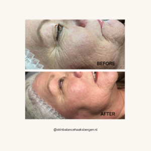 Microneedling kuur